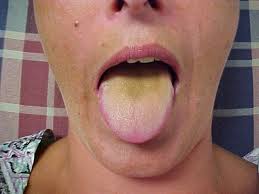 Vata toxins tongue