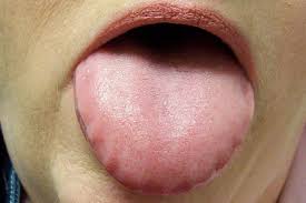 malabsorption tongue