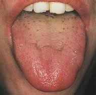 tongue digagnosis