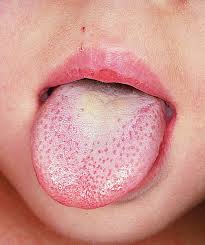 parasite tongue