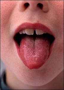 Split in middle of tongue