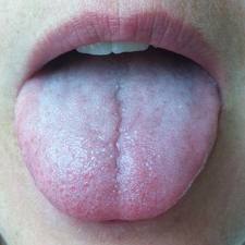 swollen tongue 2