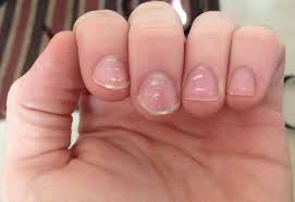 white-spots-on-the-nails